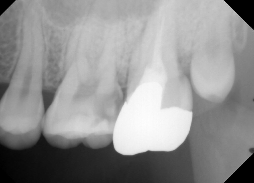 術前：歯髄に近接する大きなX線透過像あり。
